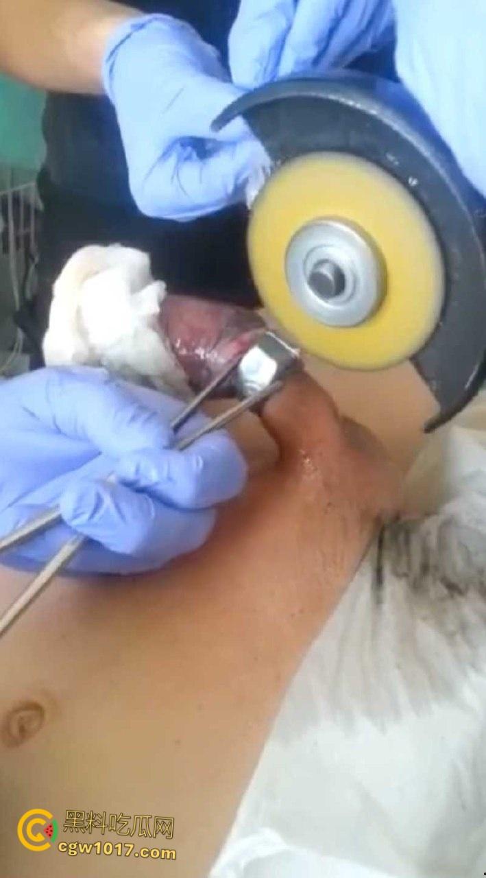 小说照进现实，男子追求刺激螺母自慰，勃起后被螺母卡住，消防人员和医生同时出动，解救被困阴茎 ！-4